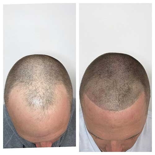 scalp-micropigmentation