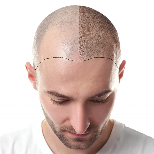 scalp-micropigmentation