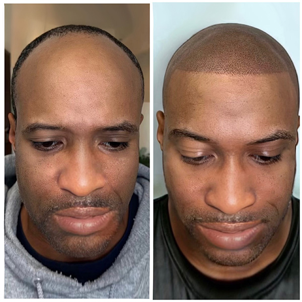 scalp-micropigmentation3